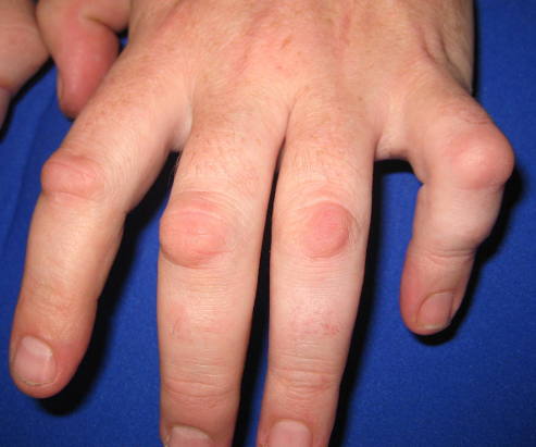 Dupuytrens Disease