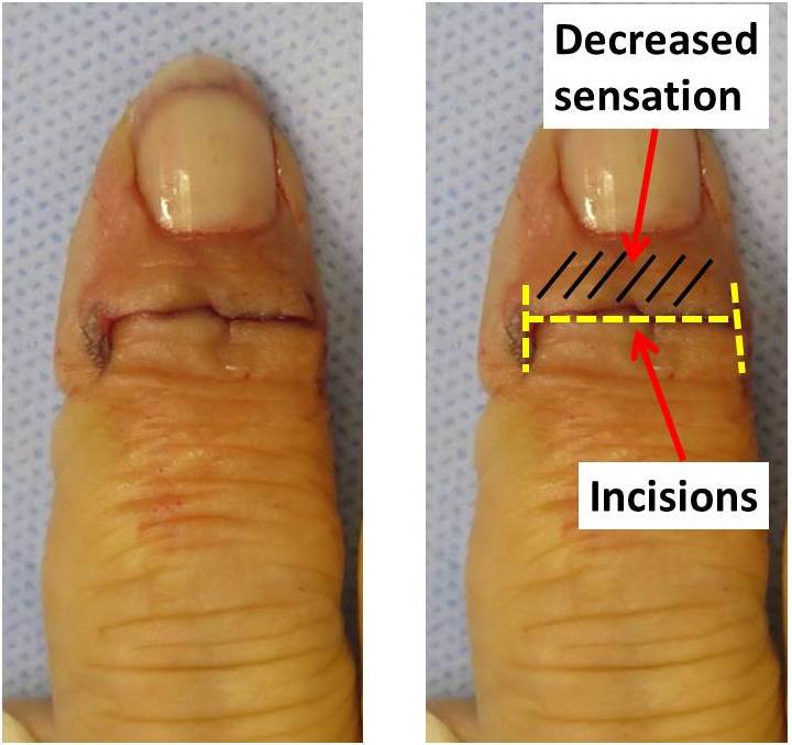 minimally-invasive-hip-replacement-recovery-time-finger-joint