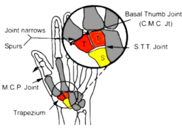 Osteoarthritis Thumb Cmc Joint 7167