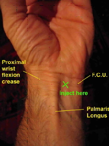 Carpal tunnel steroid injection technique