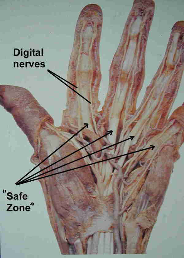 Intermetacarpal Blocks