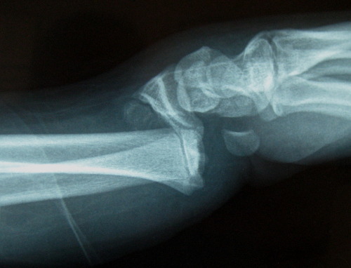 Children's Wrist Fractures