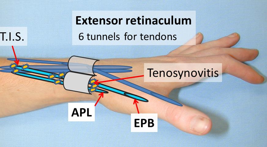 de quervains tendonitis