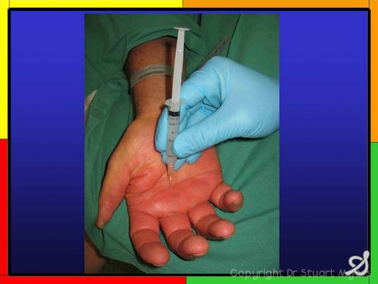 Cortisone Injections In The Hand