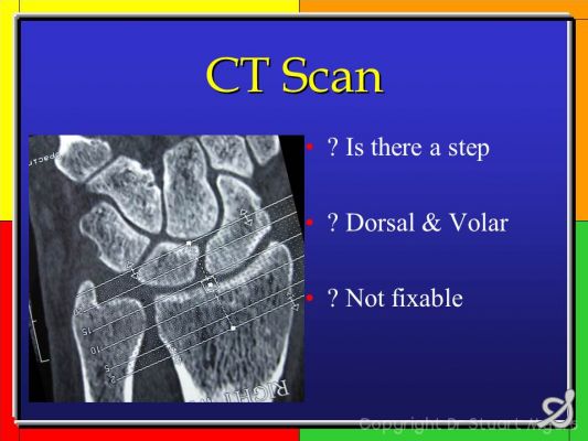 icd 9 code for colles fracture