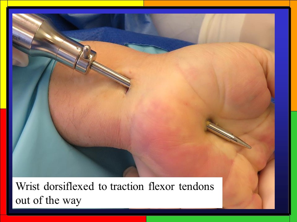 Carpal Tunnel Endoscopic