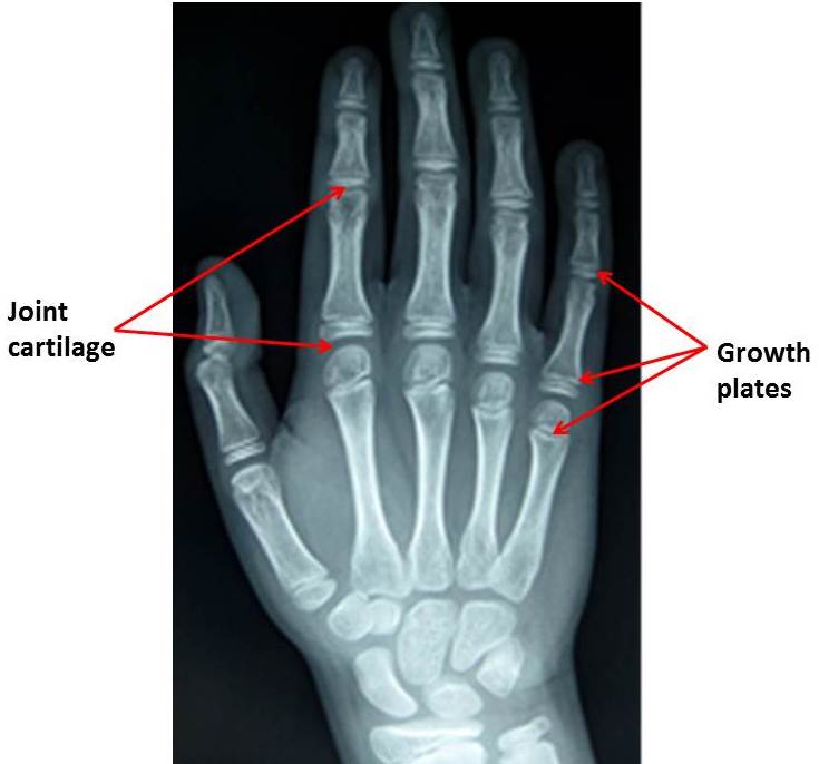 Children's Hand Fractures