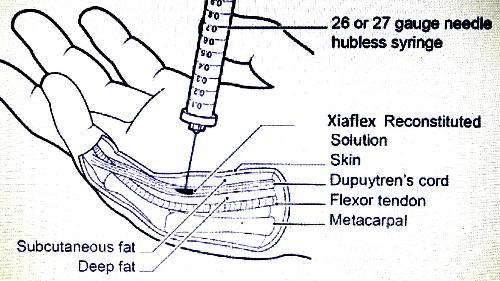 04. Dupuytrens Xiaflex Injections