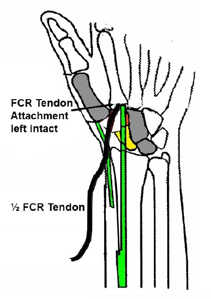 Osteoarthritis Thumb CMC joint