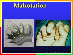 Metacarpal and Phalangeal Fractures