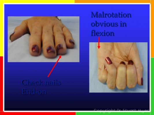 Metacarpal and Phalangeal Fractures