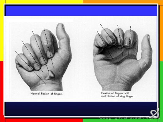 Finger Stiffness