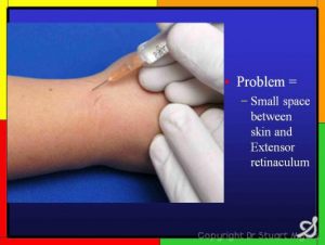 Cortisone injections in the Hand