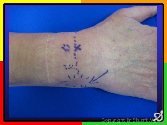 Cortisone injections in the Hand