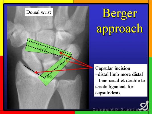 Scapholunate Ligament Repair With Capsulodesis Reinfo - vrogue.co