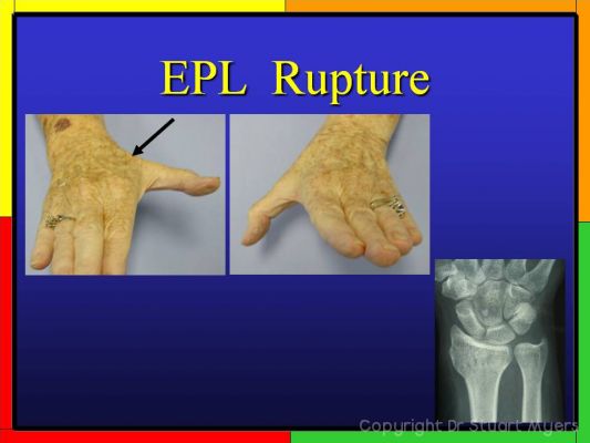 Colles Fracture Anatomy